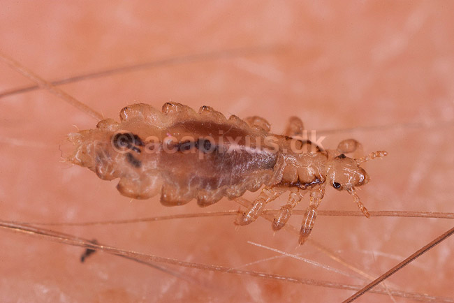 Hovedlus. Hoved lus - hunlus - blodsugende insekt - reprocessing af KOL10888; Pediculus humanus capitis; ; ; ; insekter; Egentlige lus, Siphunculata, ut�j, skadedyr, h�r, hovedbund, plettyfus, blodsugere, snyltere, snyltedyr