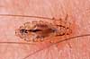 Hovedlus. Hoved lus - hunlus - blodsugende insekt - reprocessing af KOL10891 Pediculus humanus capitis    insekter Egentlige lus, Siphunculata, ut�j, skadedyr, h�r, hovedbund, plettyfus, blodsugere, snyltere, snyltedyr
